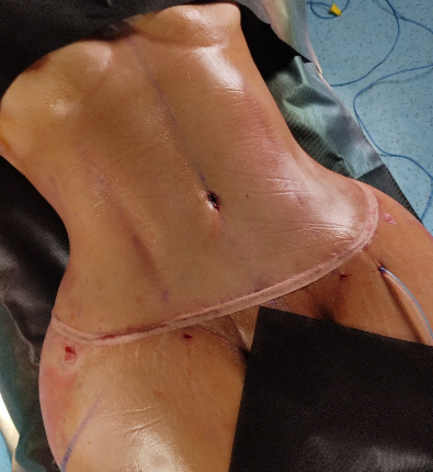 Lipoabdominoplasty