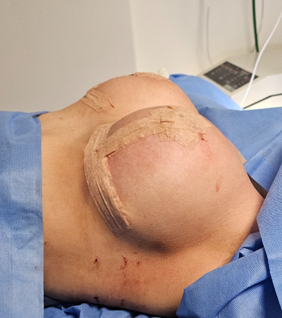 Mastopexy with implants