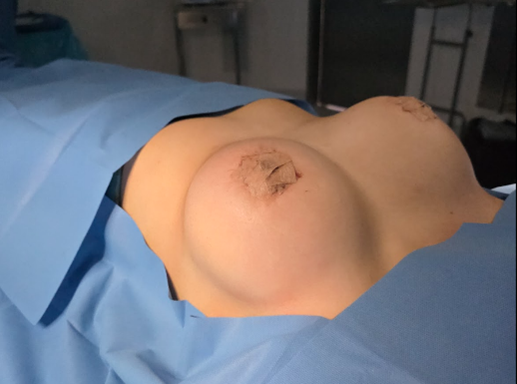 Simple breast augmentation